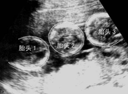 三代试管婴儿是什么意思？为什么大家都选择泰国？